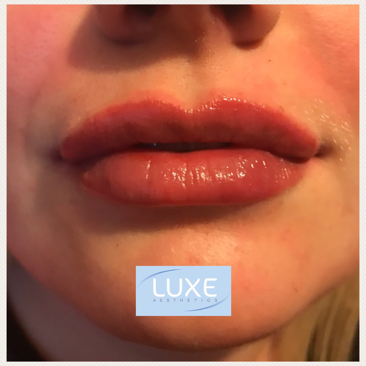 luxeaesthetics's tweet photo. Fresh off the needle @luxeaesthetics #luxeaesthetics #lips #lipfiller #pout #fullerlips https://t.co/eygmjtgSig