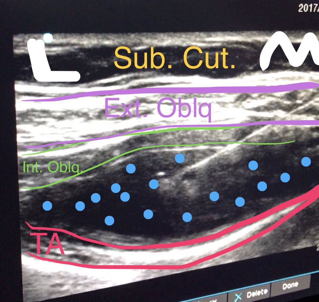 dr_tgro's tweet image. #smartphoneBLOCKS #TAPblock @SonoSite - fellow was in scrubd' in precarious position under the robot arms for block