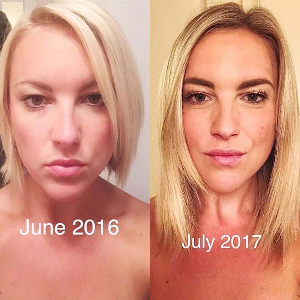 ViviscalProUS's tweet photo. What a difference a year makes!⌛️ #repost #ViviscalProfessional #myhairsecret .
.
Emily arrived to the salon for t… https://t.co/kQqNAqJy01 https://t.co/VCW2IgAsgo