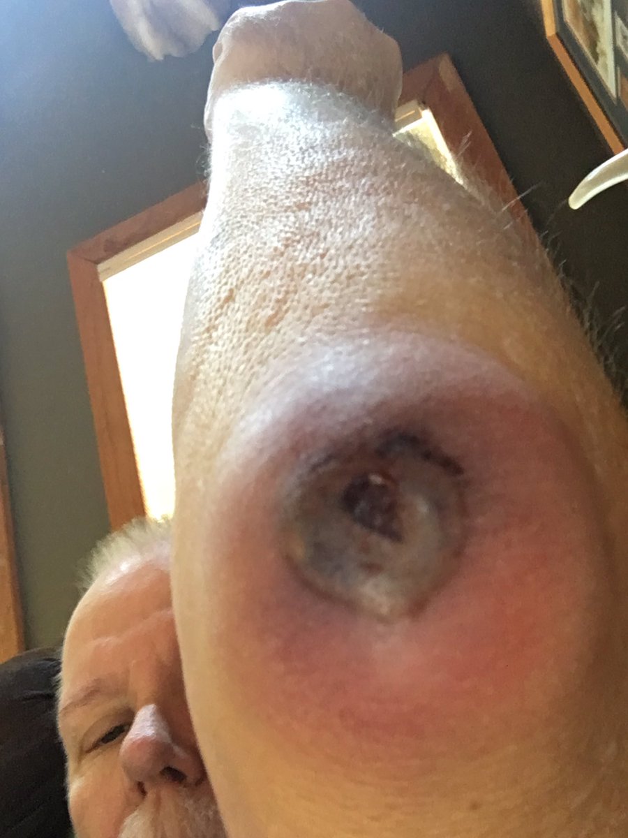 morganbow1254's tweet photo. Why is it always me. Bone chip in my elbow https://t.co/ISWUFnLqUt