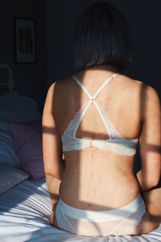 Louisa_Sadler's tweet photo. Check out and follow my new blog!!! It would be appreciated massively ☺️ https://t.co/7YcCwznGe5      #psoriasis https://t.co/RE5hvgFsW2