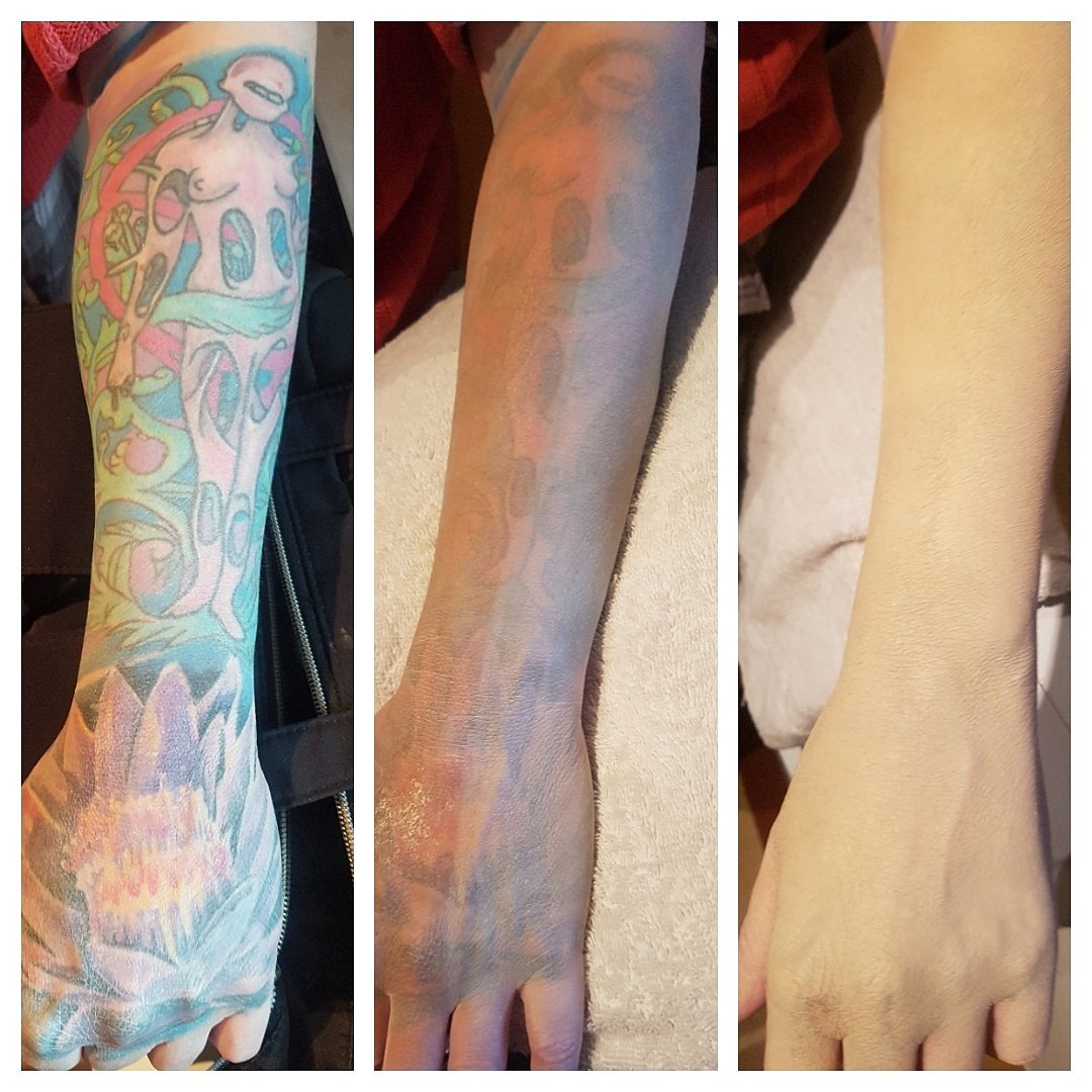 clarejgarrett's tweet photo. Camouflage session #medicalskincamouflage #skincamouflage #dermacolor #keromask #tattoocoverup #tattoos #mua #makeup #sheffieldissuper 😊 https://t.co/Z5kai7SoOe