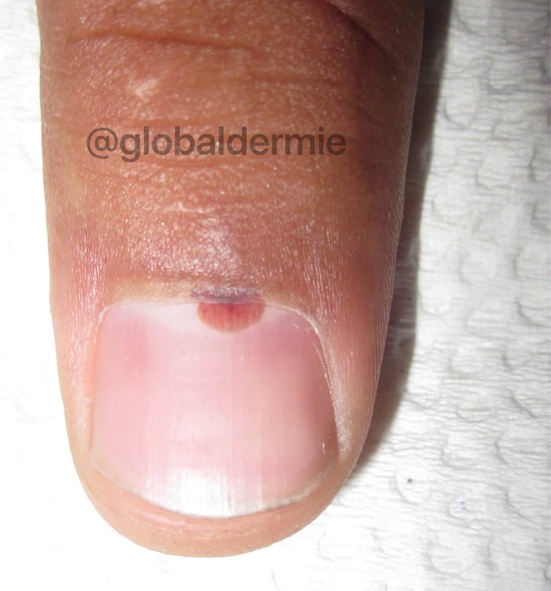 Pigmented Bands Nails Nail Ftempo