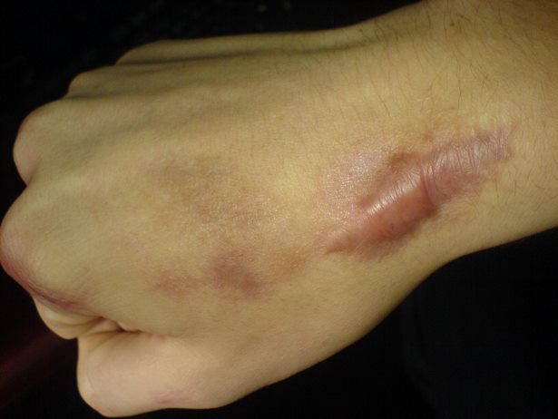 A #Keloid is an abnormal growth of scar tissue. Learn More about Keloid removal: #KeloidRemoval :
acworthderm.com/keloid-removal…