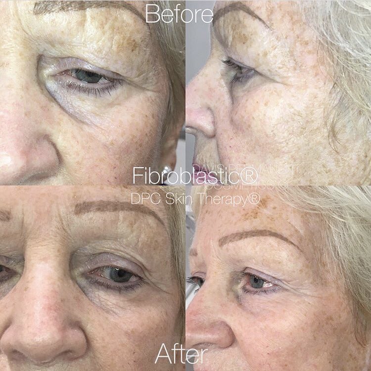 davispermcos's tweet photo. #fibroblastic™ work by Penny. #nonsurgicalskintightening #skintightening #goodskin #skinclinic https://t.co/hR4rzUiDOk