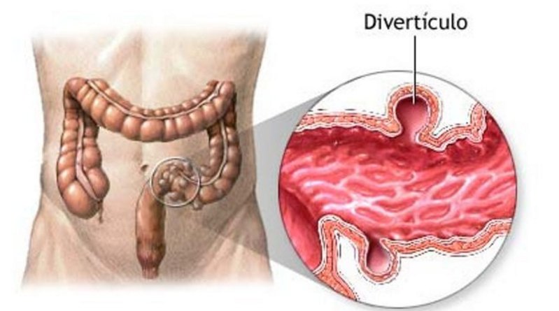 marthadebayle's tweet photo. Diverticulosis: Cuando se forman y aparecen estas bolsas.  Aparecen a partir de los 45-50 años y aumentan con la edad @DrVAlarcon https://t.co/esTc8FJ8ri