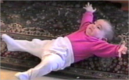 Cannabinoides y síndrome de West: ¿una alternativa válida y de bajo costo? goo.gl/G74KRG