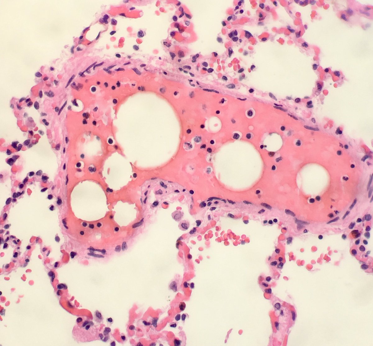 seattlequinns's tweet image. Fat emboli: ~85% of trauma patients w/ attempted resuscitation have fat emboli at autopsy. Why else? #pulmonarypath #forensicpath