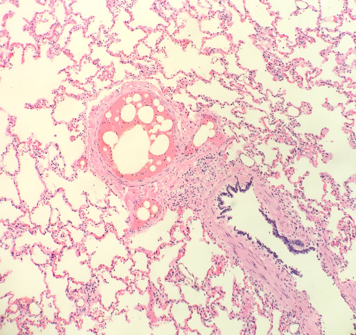 seattlequinns's tweet image. Fat emboli: ~85% of trauma patients w/ attempted resuscitation have fat emboli at autopsy. Why else? #pulmonarypath #forensicpath