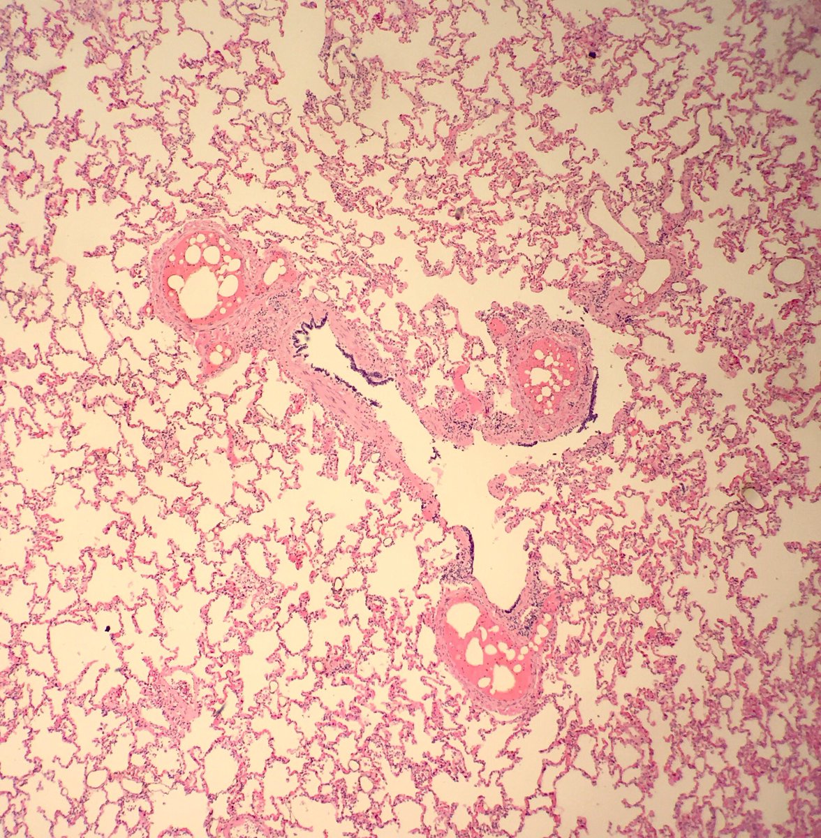 Fat emboli: ~85% of trauma patients w/ attempted resuscitation have fat emboli at autopsy. Why else? #pulmonarypath #forensicpath