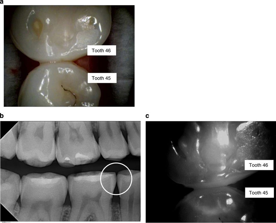 The_BDJ's tweet photo. How effective is near-infrared light in detecting approximal enamel lesions? #BDJOpen https://t.co/0MpovhMcyJ (free) https://t.co/6T4LP0Op11