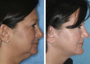 medispas10's tweet photo. Our long awaited is a fat reduction for the chin is now available! https://t.co/kjOMaH8LYr #SheffieldIsSuper #ChinReduction https://t.co/Rlsr8TmeVO