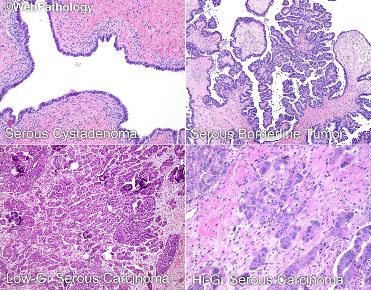 WebPathology's tweet photo. #GynPath update: Serous Ovarian Tumors, 111 images; https://t.co/gijrtEyjbj; #ovariancancer #pathology @Pathologists @Pathoutlines @GynPath https://t.co/OHFPSF9cL6