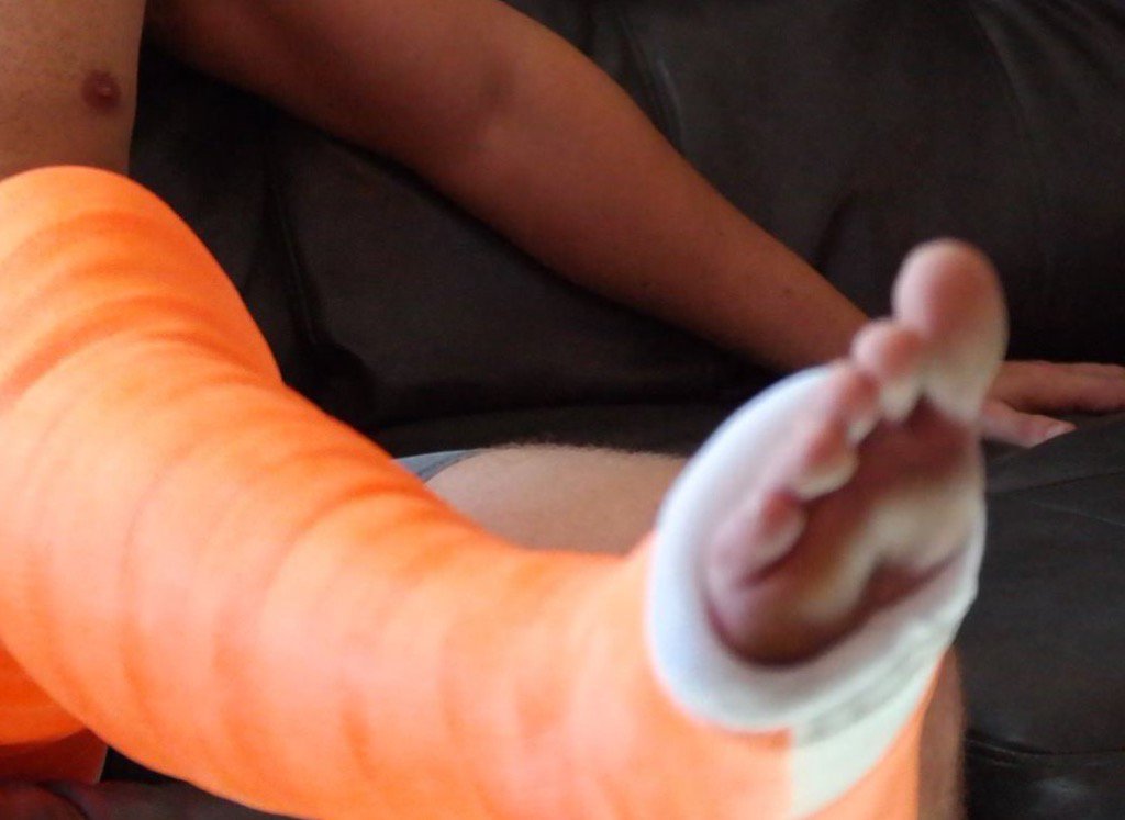 Toesnacast's tweet photo. #llc #castboy #brokenleg https://t.co/8cJXOOpc89