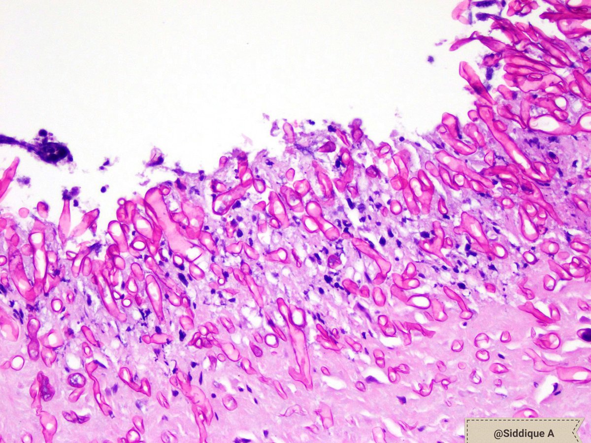 SiddiqueA_MD's tweet photo. Angioinvasive mucormycosis #pathbeauty #disseminated #immunocompromised https://t.co/o8DwCxCsqj
