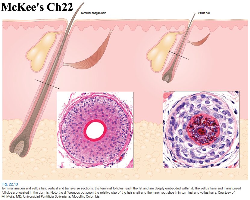 Terminal Hair Vs Vellus Hair