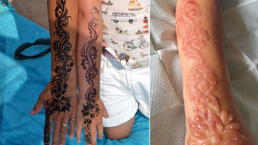 Pelágico Flojamente Anuncio Cuatro al Twitter: "Un tatuaje de henna deja horribles quemaduras a una  niña de siete años&gt; https://t.co/cVtYQumJpw https://t.co/EoW20g2cEa" /  Twitter