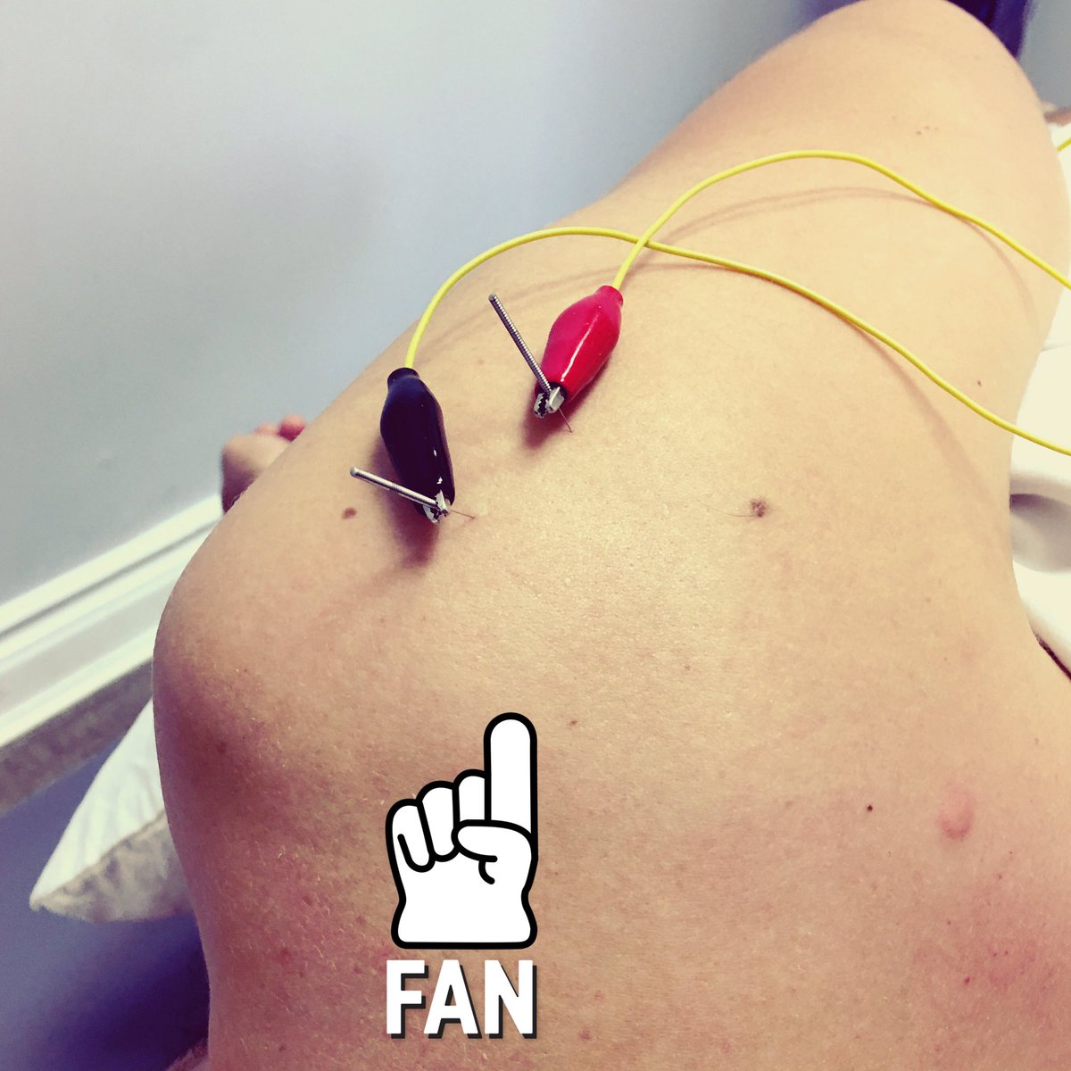 NOTLhealthwell's tweet photo. Acupuncture, soft tissue, and rehabilitation is a great way to treat a rotator cuff strain!! https://t.co/fhC3uHo4CF