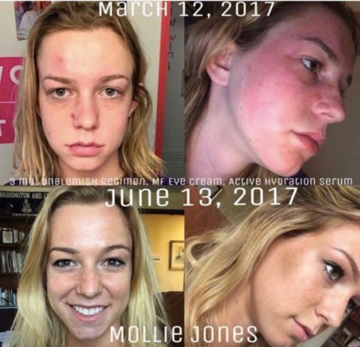 HCapra's tweet image. Dedicate the time, use the products in the right way, in the right order. Mollie did &amp;amp; look at her results! She's a PC and luvs the results