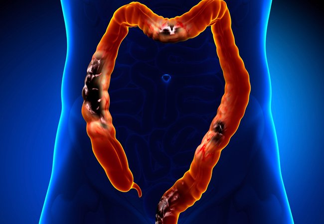 ivpharmacist's tweet photo. New Colon Cancer Prognostic Biomarker: A ‘Potentially Important Clinical Advance’ https://t.co/J4IraQORvn https://t.co/yHQQLiGwZT