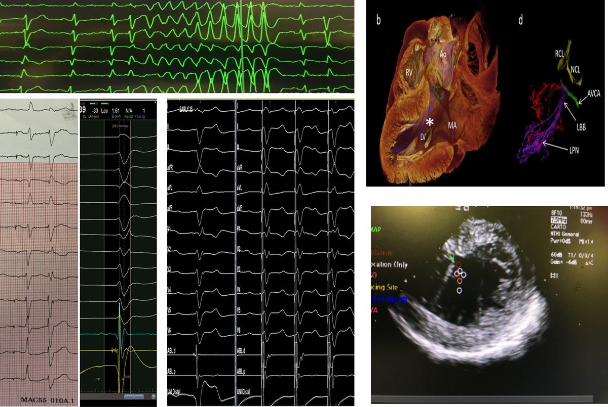 Culprit PVC ablated from LPF. Many pts can be helped if can identify culprit PVC <a href="/DrFerminGarcia/">Fermin Carlos Garcia</a> @juanjosanmu1963 <a href="/aalahmadmd/">Amin Al-Ahmad, MD</a> <a href="/SergioPinski/">Sergio Pinski</a>