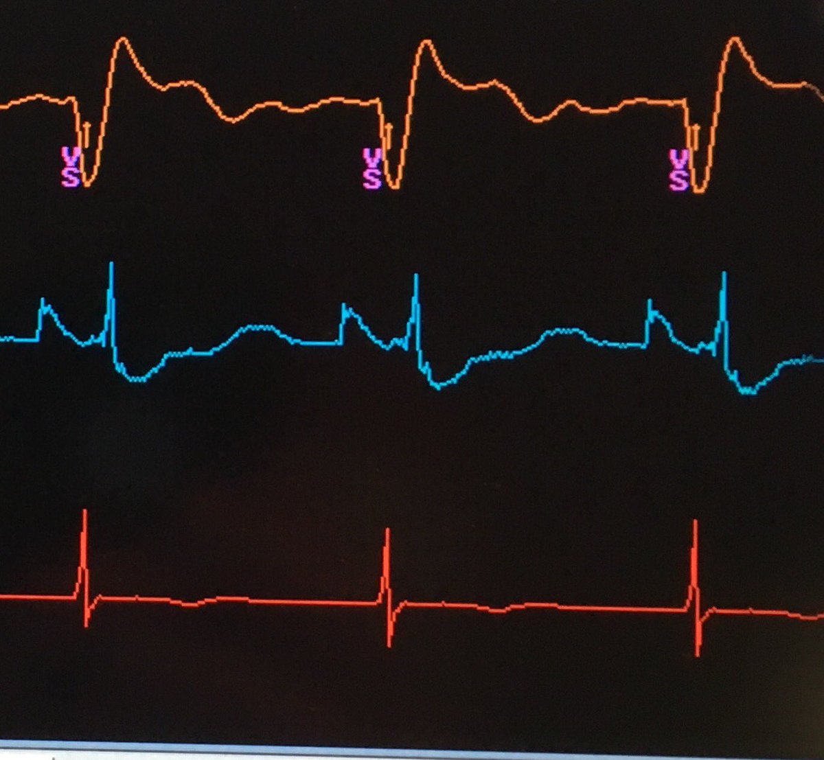 S-HBP, classical His injury &amp; excellent pacing threshold 0.5@0.4