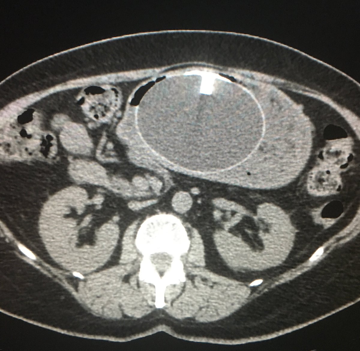 ryantfitzgerald's tweet photo. An Orbera non-surgical intra-gastric weight loss balloon in action! https://t.co/2uIdLO4tu8