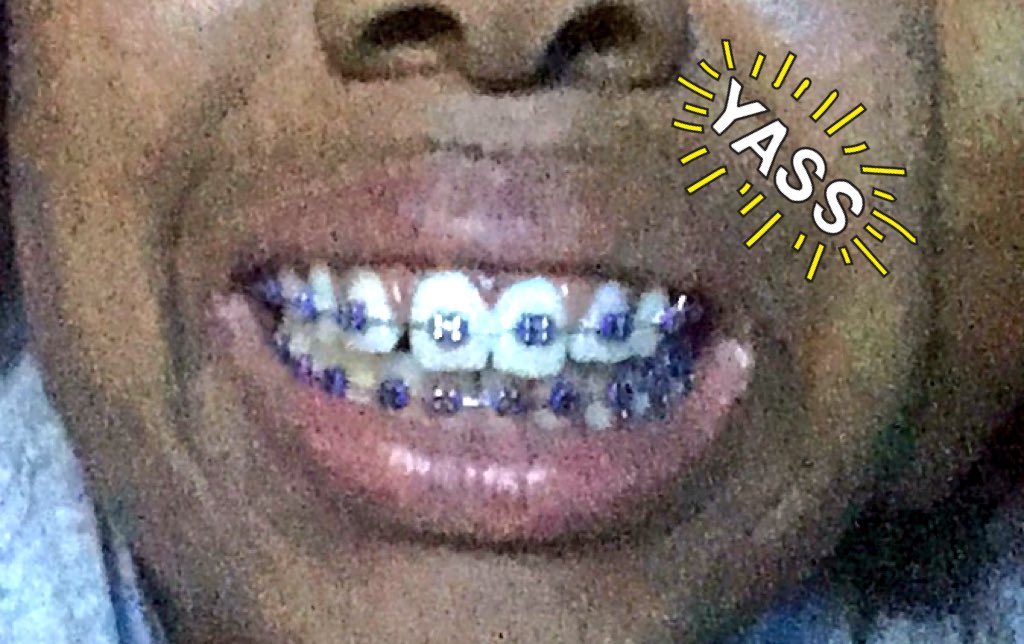 PookaWasHere's tweet photo. 3 months with my braces! New color (finally) I have purple now :) https://t.co/7tPOtIqccT