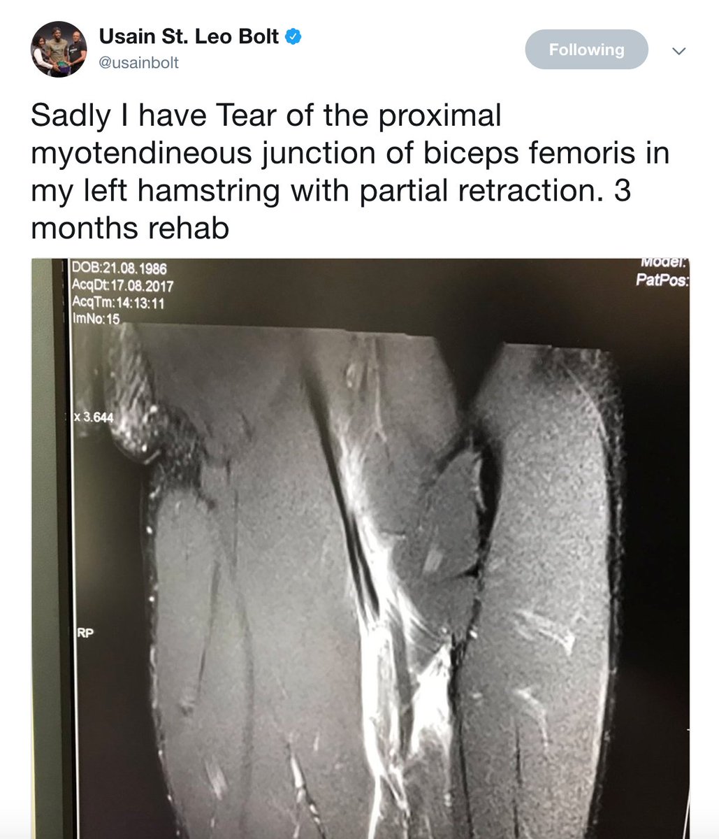 trackstream_org's tweet image. Bolts overshadows critics and goes public with his injury
Read article here &amp;gt;&amp;gt; @usainbolt trackstream.org/articles