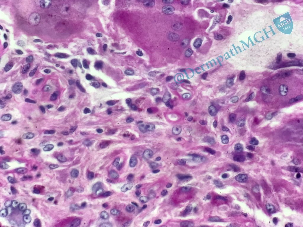 Widespread papules&amp;arthritis. Histiocytes, giant cells w/"GroundGlass" 2tone cytoplasm. PAS-D+: Multicentric Reticulohistiocytosis #Dermpath
