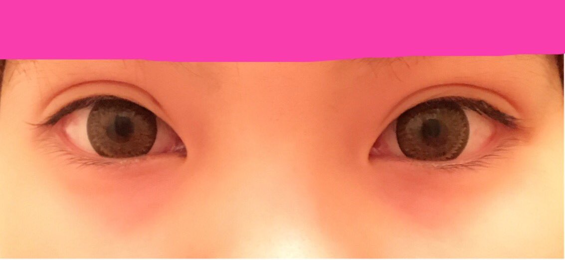 むちこ 19 鼻dt 埋没1年目くらい むかって右は理想通りだけど 左は少し欲張りすぎた感が否めない 平行二重を希望したんで 蒙古襞の張りが強い右目は多分このくらい幅を取らないと末広型になっちゃったんだと思う 次するなら目頭切る