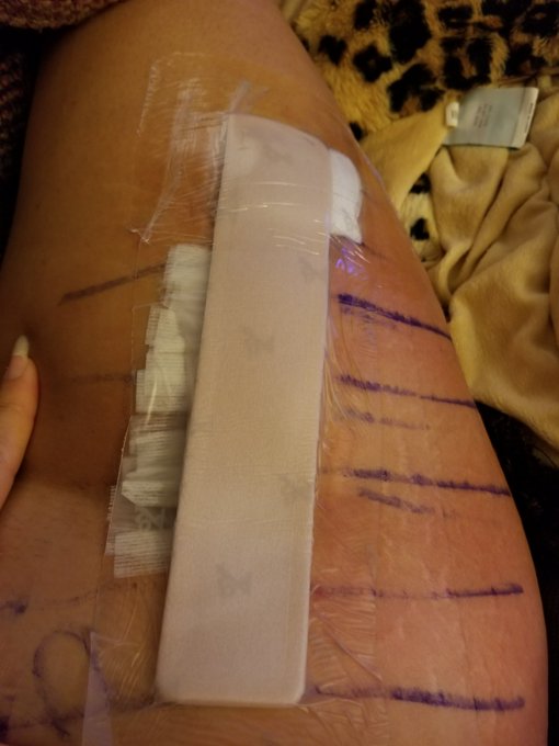 My very swollen hip.  #hipreplacement day 3 https://t.co/bwljwCH7DR<a href="/tag/hipreplacement"class="tags">#hipreplacement</a>