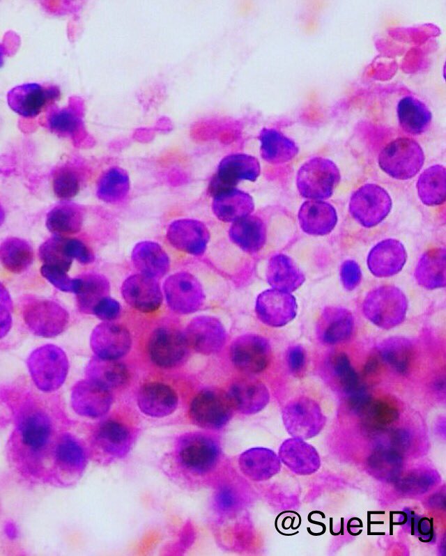 SueEPig's tweet photo. Large polygonal cells with clear cytoplasm, uniform round nuclei and inconspicuous nucleoli #RCC #clearcells  #cytology #smear #hhpath https://t.co/dUl7jRZEIX
