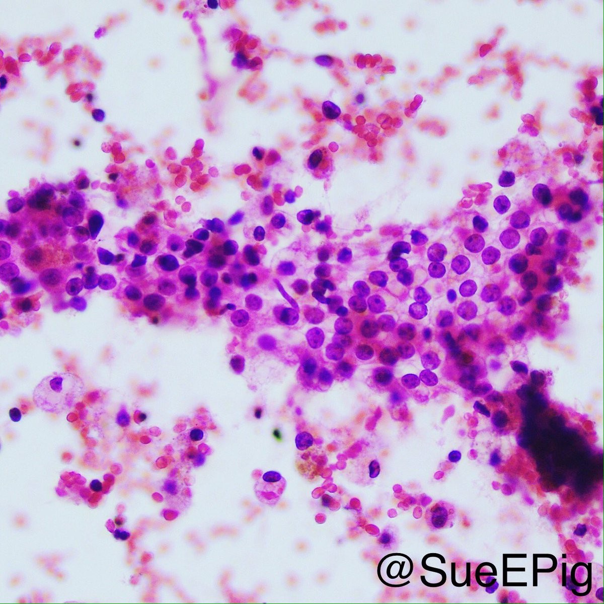 SueEPig's tweet photo. Large polygonal cells with clear cytoplasm, uniform round nuclei and inconspicuous nucleoli #RCC #clearcells  #cytology #smear #hhpath https://t.co/dUl7jRZEIX