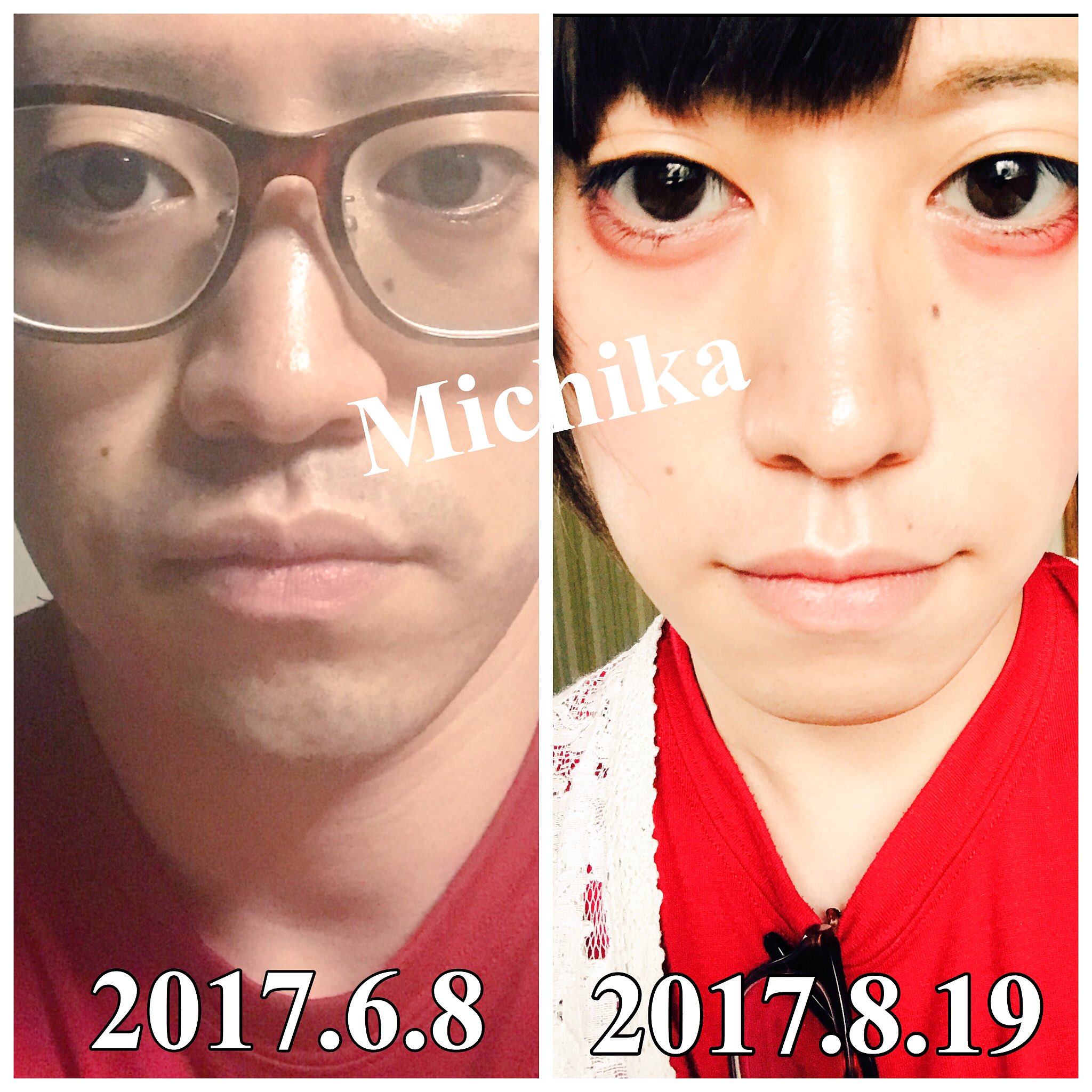 Michika 女性ホルモン開始から2ヶ月 Amp ヒゲ脱毛でけっこうかわる セクマイ Mtf ビフォーアフター 自撮り T Co Nkxcdoyjpk Twitter Michika 女性ホルモン開始から2ヶ月 Amp ヒゲ脱毛でけっこうかわる セクマイ Mtf ビフォーアフター 自撮り T Co Nkxcdoyjpk Twitter