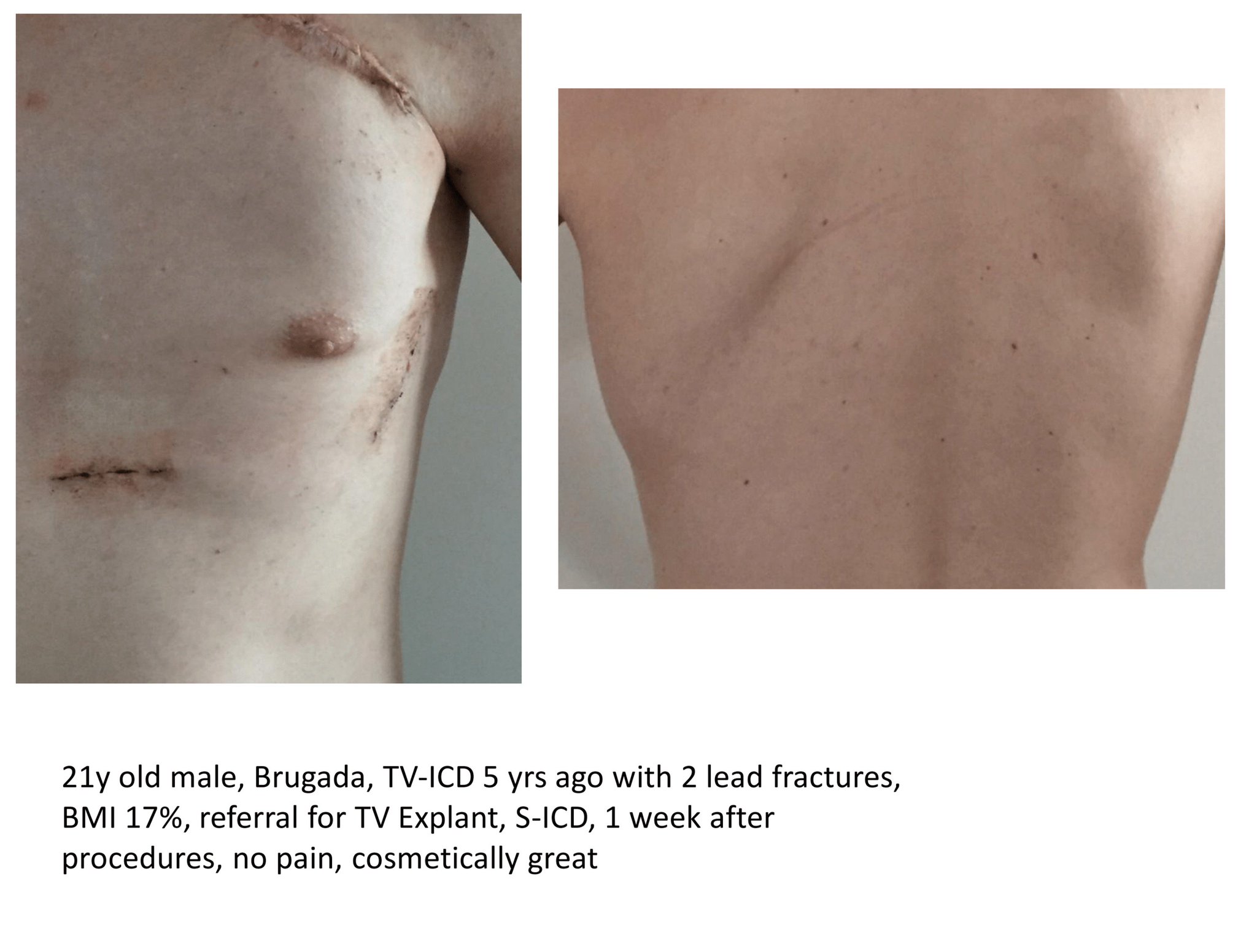 Juergen Kuschyk Md Phd S Icd And Low Bmi Good Functional And Cosmetic Results With Intermuscular Approach Next Tweets On Extremely High Bmi And S Icd T Co Sobyjkgqnx