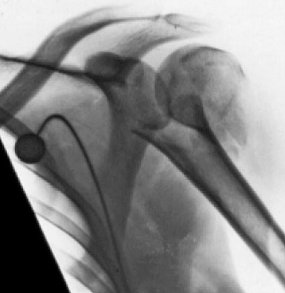 MillettMD's tweet photo. 80% of #proximalhumerus fractures are well managed nonsurgically. The remaining 20% present a therapeutic challenge https://t.co/We66IgifH5 https://t.co/gwOWjHdKeC