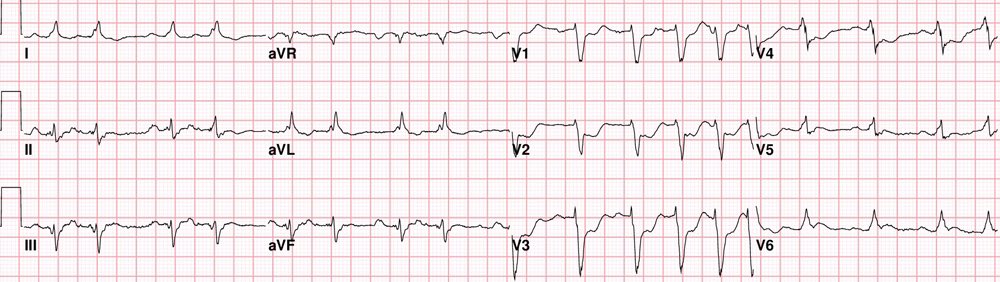 Sam Ghali On Twitter This Is A Very Important ECG Pattern That Adorable Ecg Pattern Sam Ghali On Twitter This Is A Very Important ECG Pattern That Adorable Ecg Pattern