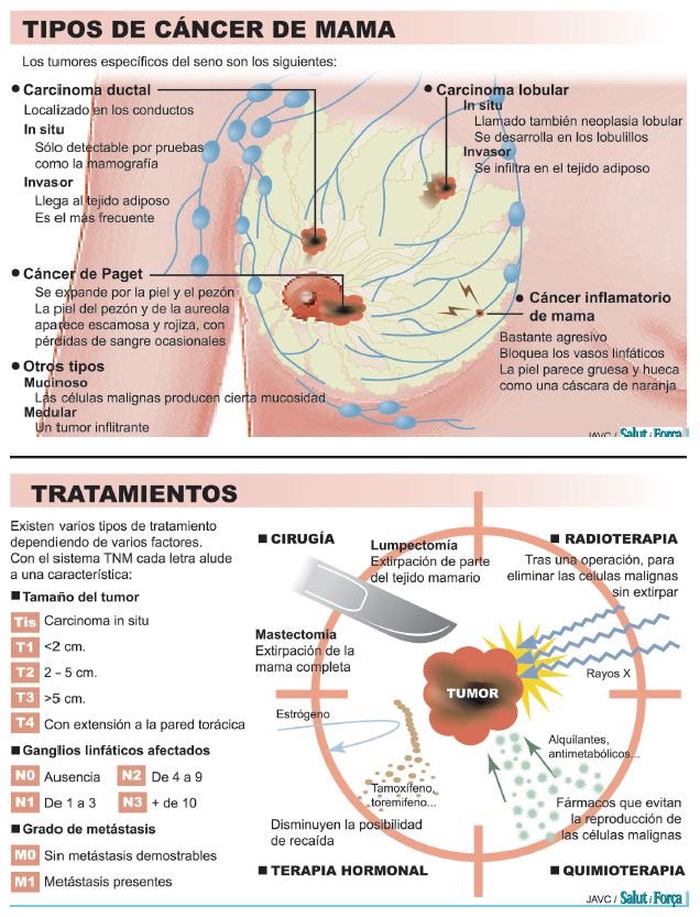 Drlapman's tweet photo. Tipos de #cancer de mama https://t.co/7DBOVoY3GU https://t.co/mmS7ebxId4
