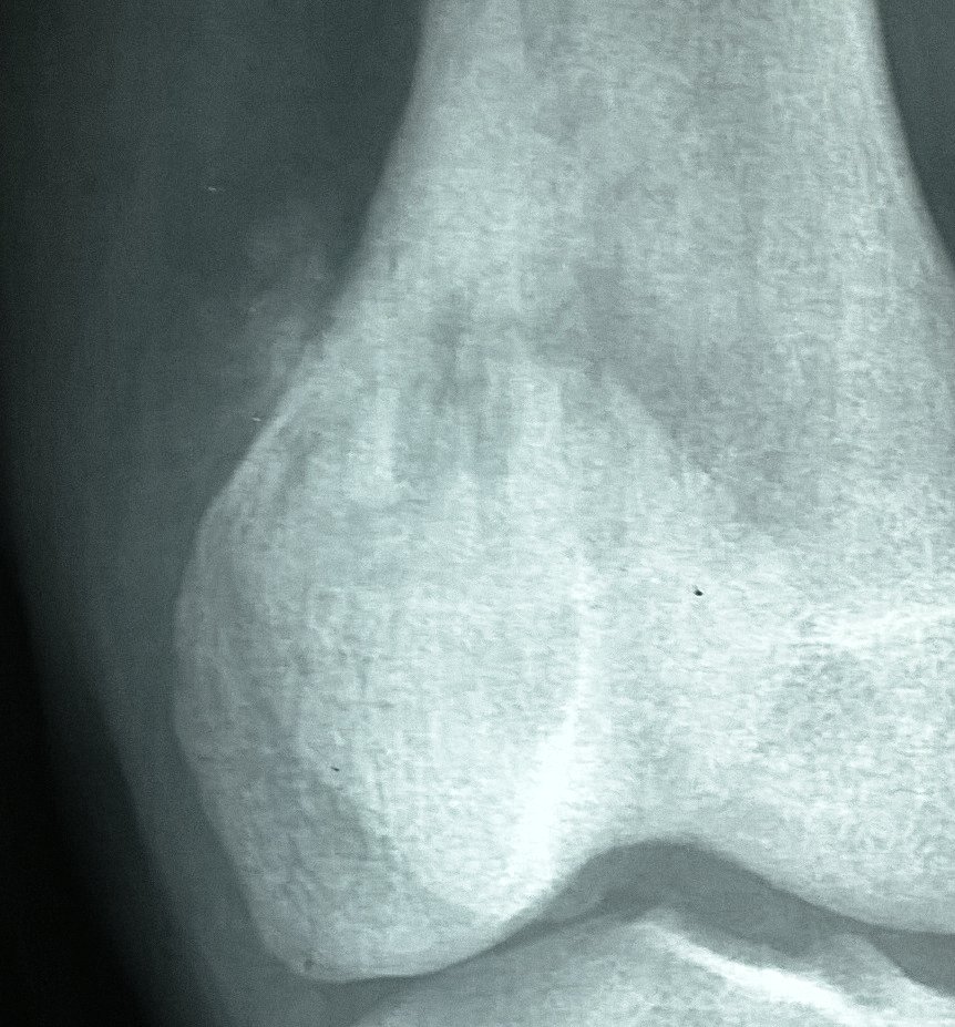 Genoprecision's tweet photo. 17 years old patient.  #Osteosarcoma #Sarcoma #Osteoid #BSTpath https://t.co/Ga7QyZC37k