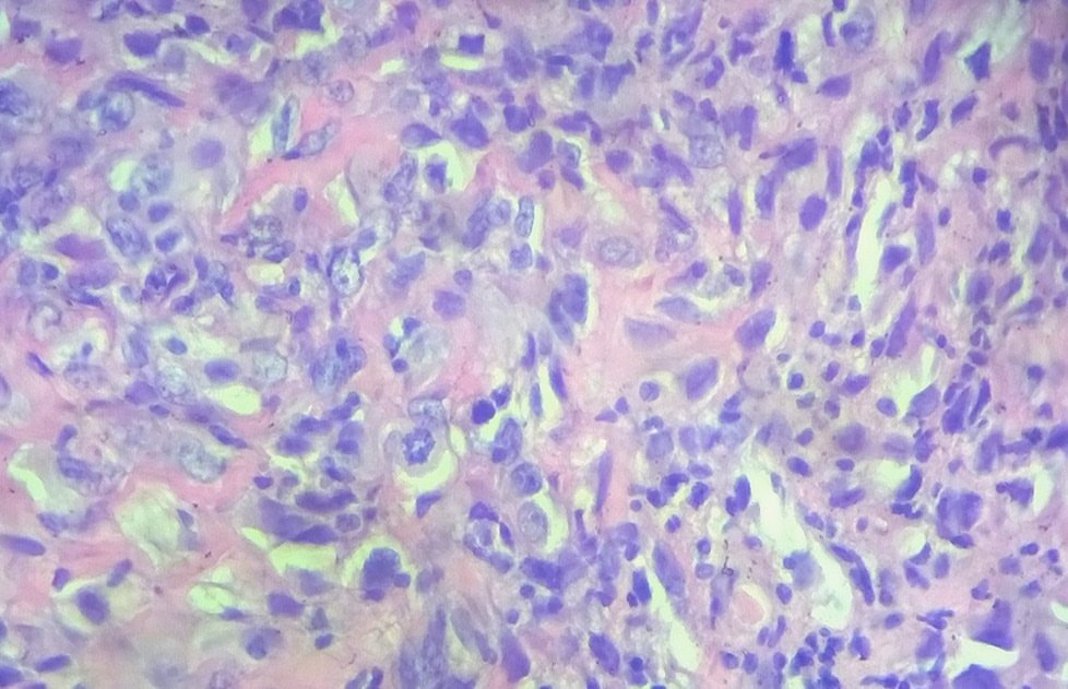 Genoprecision's tweet photo. 17 years old patient.  #Osteosarcoma #Sarcoma #Osteoid #BSTpath https://t.co/Ga7QyZC37k