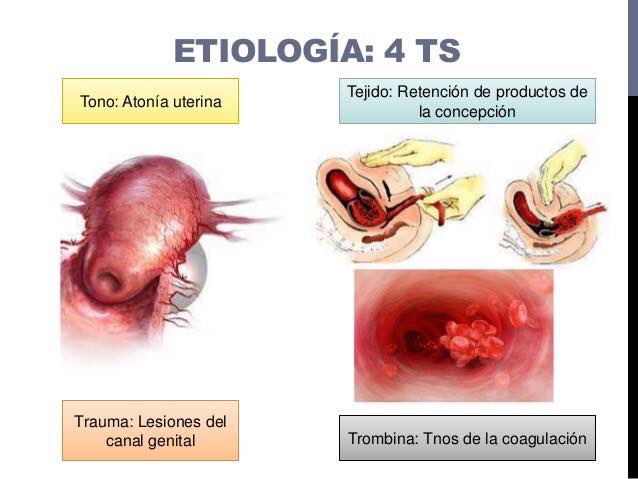 Anaesthetist_81's tweet image. Las 4 &apos;T&apos; para hemorragia obstétrica #Anestesia #AnestesiaObstétrica #HemorragiaObstétrica