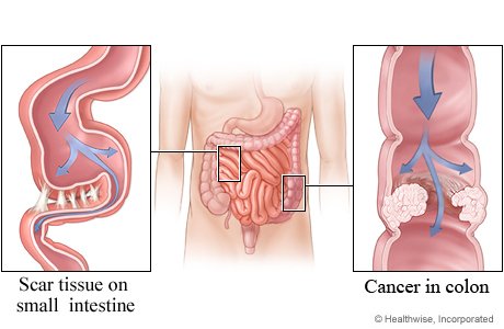 #Laparoscopic #rectalcancer resection👉🏿a ⏬ risk of #surgery👉🏿adhesive #smallbowelobstruction bit.ly/2x67wPJ @WileyOpenAccess