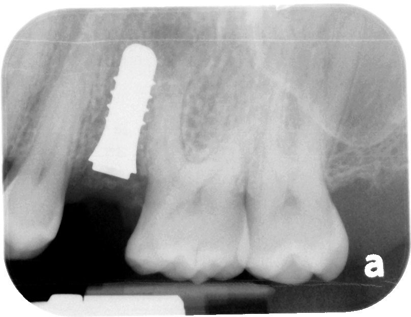 DrNoumbissi's tweet photo. Today at #milesofsmilesimplantdentistry
Exellent primary stability.
#ceramicdentalimplant #pureimplants #zirconiaimplants #iaoci2018 https://t.co/Sg2refTkx1