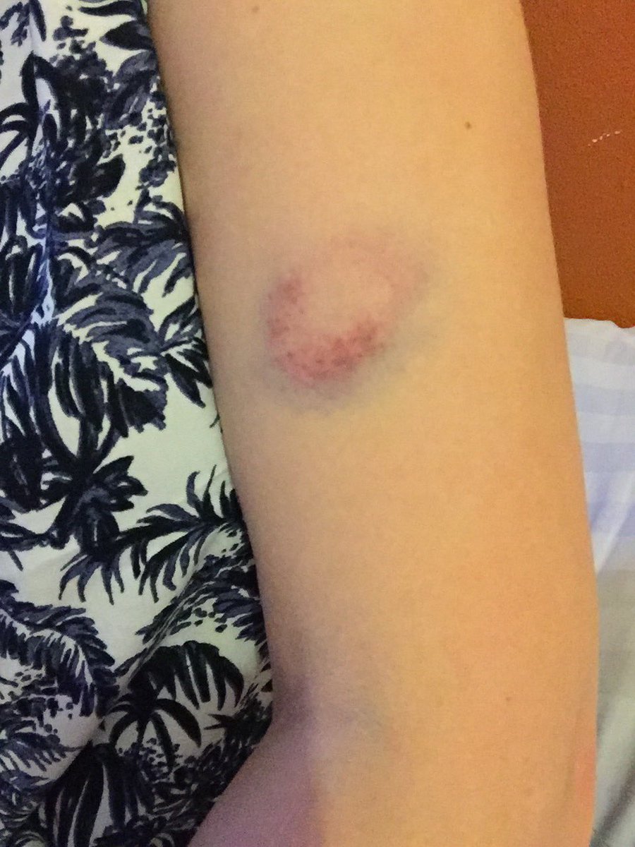 alilings's tweet photo. @Banks My bruise 1st Day vs 2nd, turning red not yellow https://t.co/1WwLBIfbqp