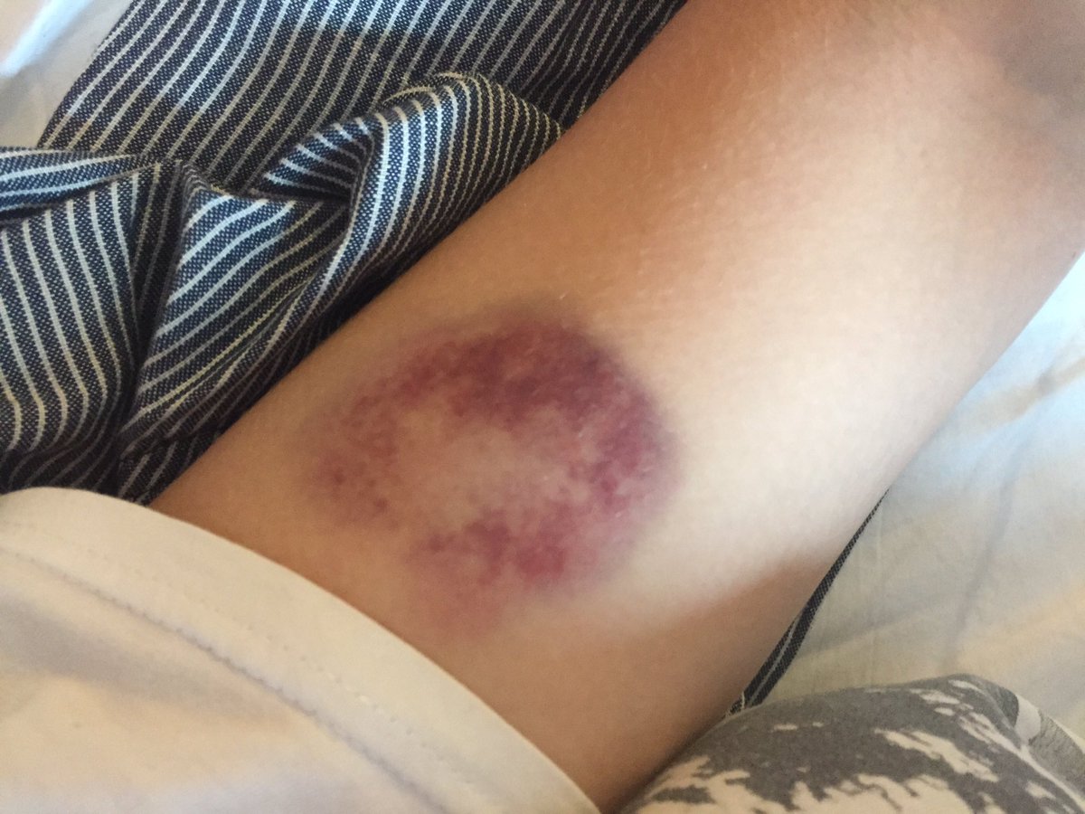 alilings's tweet photo. @Banks My bruise 1st Day vs 2nd, turning red not yellow https://t.co/1WwLBIfbqp