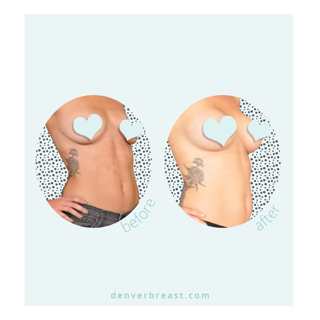 Denver_Breast's tweet photo. Get $250 off your breast procedure now and experience the magic of Dr. B for yourself!
#denver #colorado #beauty #womenshealth #implants https://t.co/SY4lY2kuPO