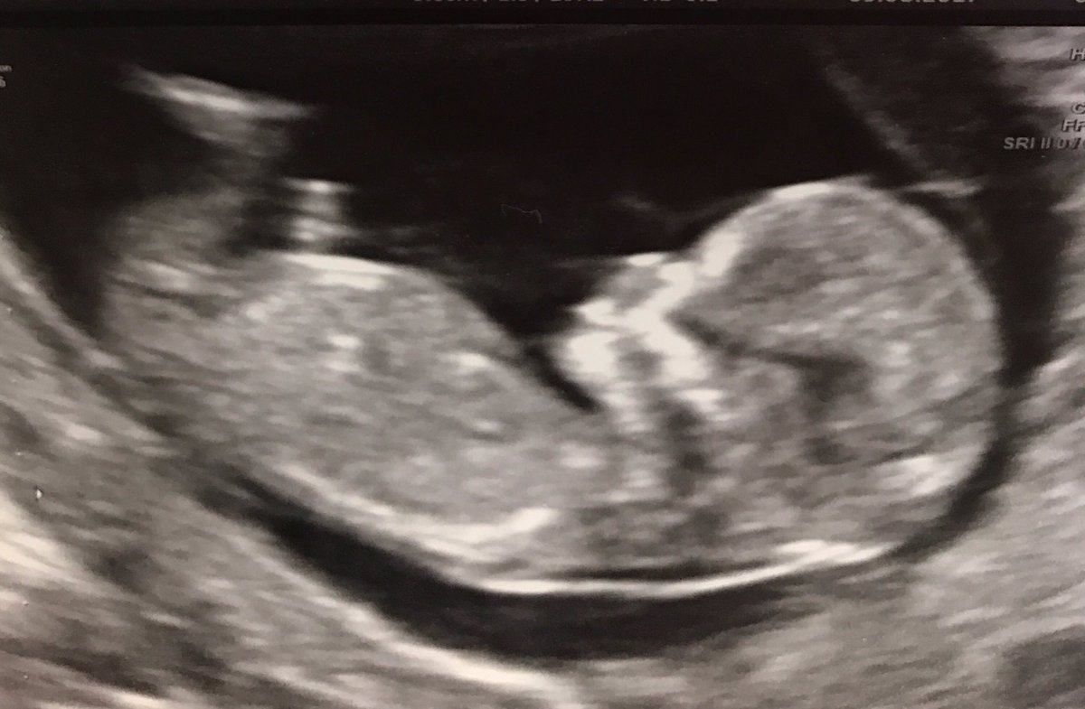 n_thomas14's tweet photo. It's a girl another granddaughter and sister for Jackson 😍😘💕 https://t.co/ckv1fF4Ftp