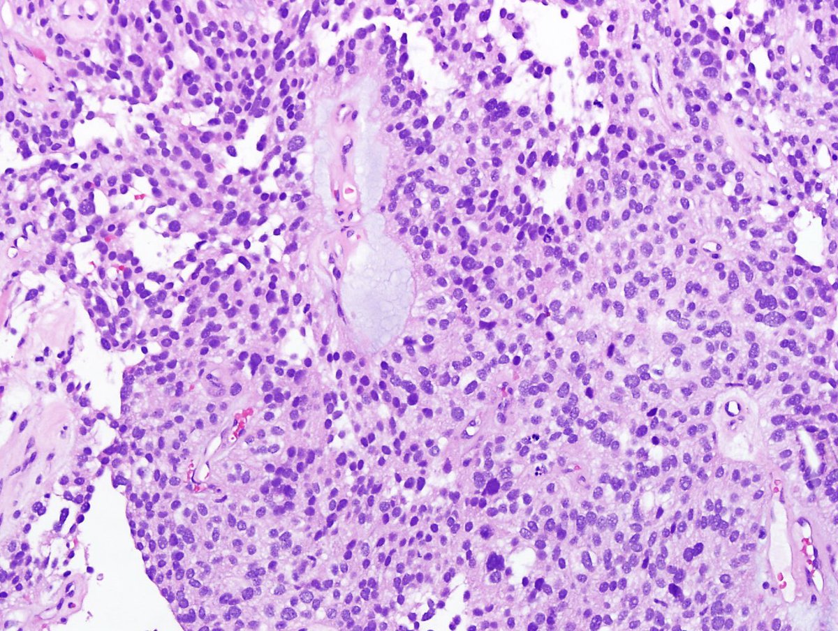 Hopkins Neuropath tweet media
