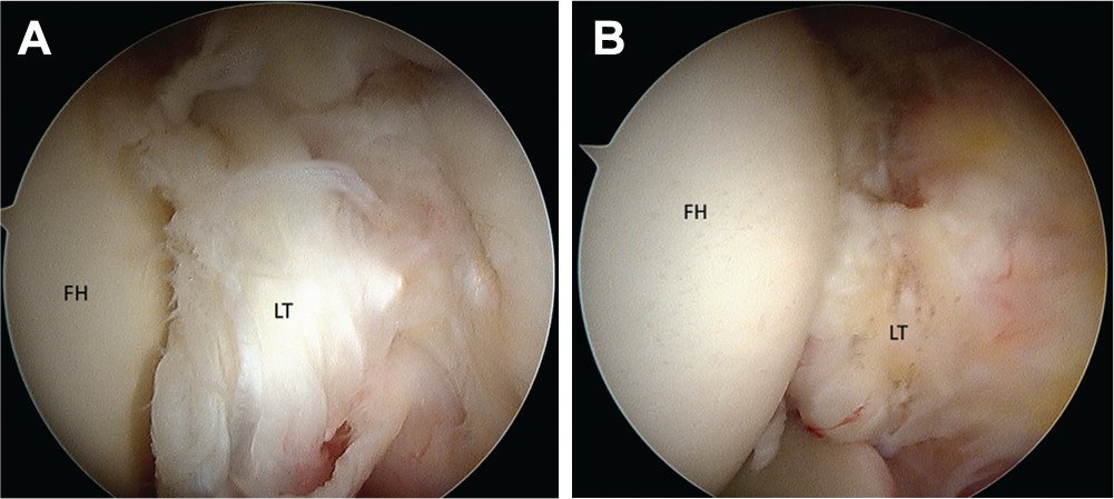 aossmjournals's tweet photo. Can a ligamentum teres tear in patients with borderline dysplasia impact outcomes after arthroscopic hip surgery? https://t.co/4XxkuRDkmP https://t.co/6e7yvAzgIy